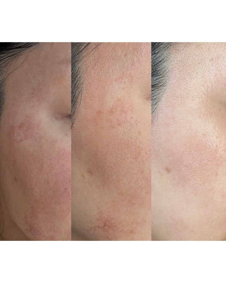 CHAGA TENSION AMPOULE SERUM